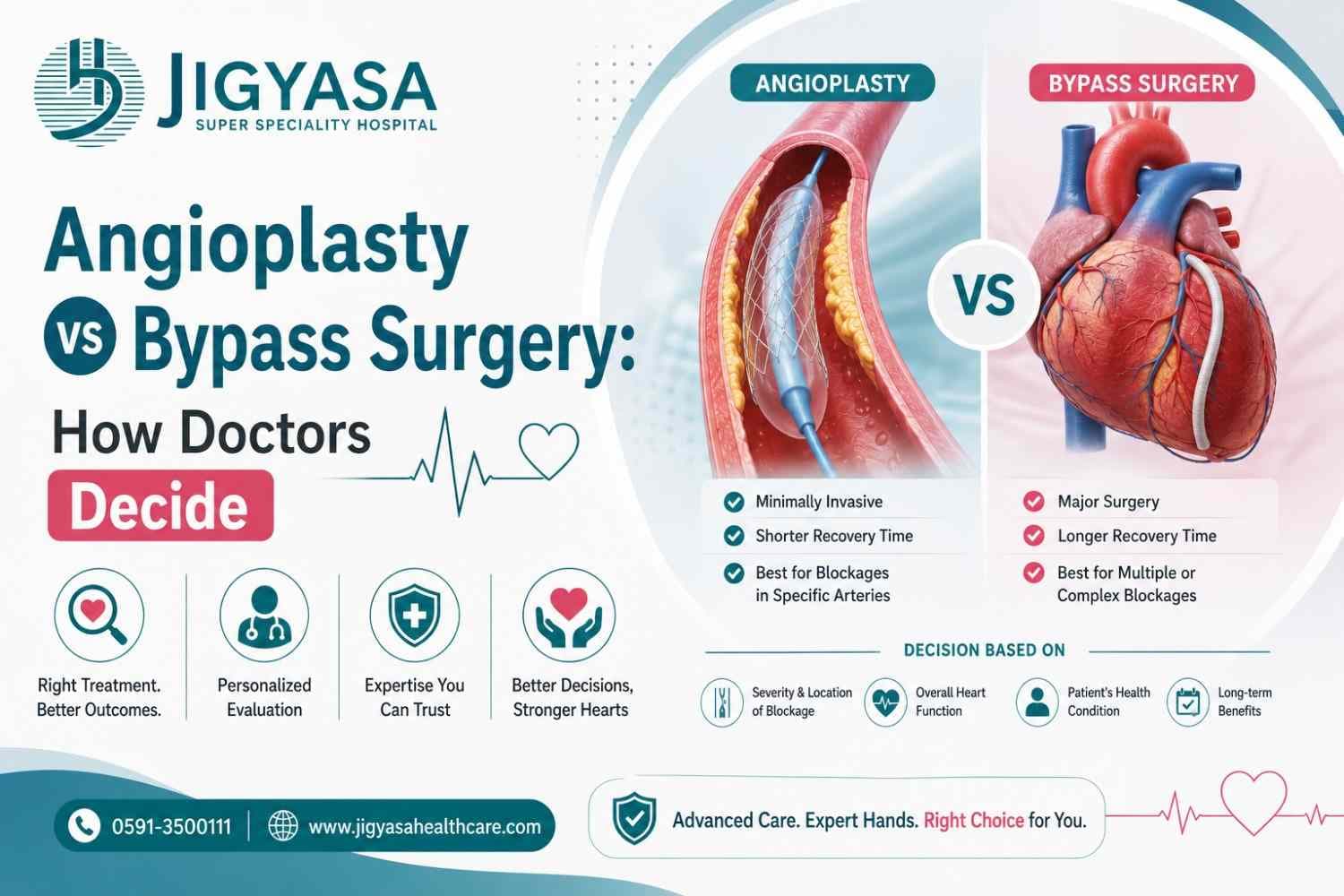 Angioplasty vs Bypass Surgery: How Doctors Decide
